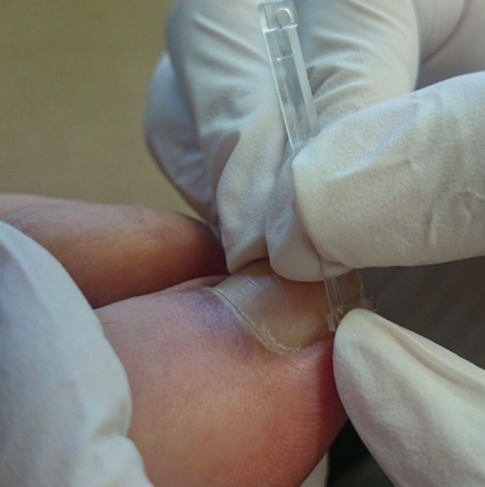 STEP3 プレートの取付け