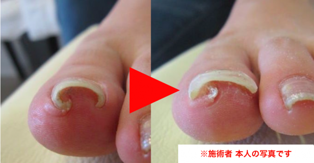 埼玉巻き爪お助け本舗